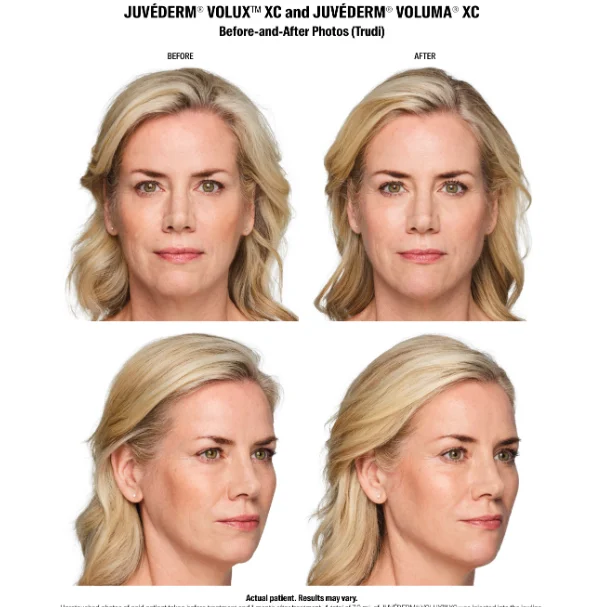JUVÉDERM VOLUX XC and VOLUMA XC before-and-after photos from the front and side. Individual results may vary.